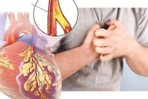Đau ngực có phải do bệnh mạch vành?