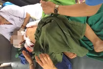 Bé 7 tuổi ở Thái Nguyên bị chó cắn phải khâu 200 mũi đã tử vong