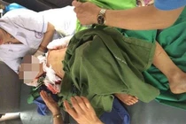 Bé 7 tuổi ở Thái Nguyên bị chó cắn phải khâu 200 mũi đã tử vong