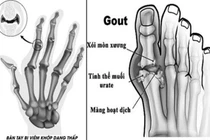 Cách chặn các bệnh xương khớp mùa đông