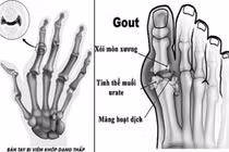 Cách chặn các bệnh xương khớp mùa đông