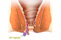 Bệnh trĩ điều trị càng sớm càng đơn giản