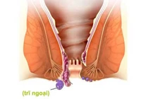 Bệnh trĩ điều trị càng sớm càng đơn giản