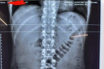 Phim chụp X-quang dị vật trong bụng bệnh nhân