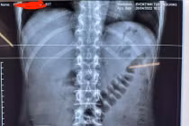 Phim chụp X-quang dị vật trong bụng bệnh nhân
