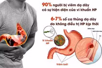 Cách trị loét dạ dày có HP