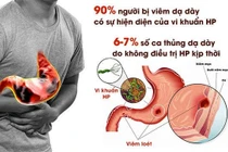 Cách trị loét dạ dày có HP