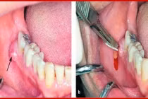 Viêm tấy vùng sàn miệng nguy hiểm tính mạng