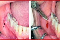 Viêm tấy vùng sàn miệng nguy hiểm tính mạng