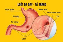  9 tuổi đã viêm loét dạ dày, hành tá tràng do vi khuẩn HP 