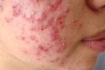 Đổi thuốc liên tục