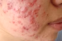 Đổi thuốc liên tục