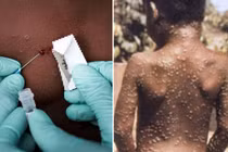Virus đậu mùa khỉ nhiều đột biến không ngờ 