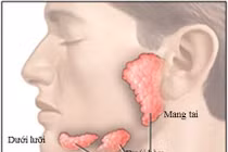 Viêm tuyến nước bọt sau uống xạ 