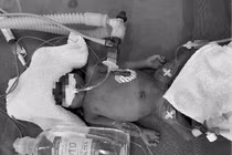 Phẫu thuật thành công tim bẩm sinh cho trẻ nặng 1kg