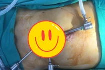 Nội soi đặt lưới điều trị thoát vị bẹn