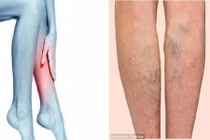 Nổi mạch máu ở chân có thể là triệu chứng của nhiều bệnh