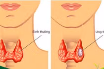 Điều trị từng thể ung thư tuyến giáp