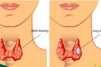 Điều trị từng thể ung thư tuyến giáp