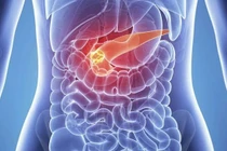 CA 19-9 giúp phát hiện sớm ung thư tụy 