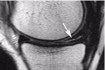Điều trị rách sụn chêm