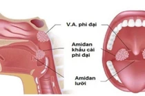Chỉ định và chống chỉ định nạo VA