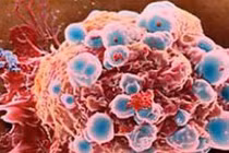 6 bệnh ung thư hay gặp ở phụ nữ