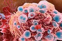 6 bệnh ung thư hay gặp ở phụ nữ