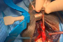 Một chiếc vít dài 6cm dính chặt vào niệu đạo người đàn ông 45 tuổi