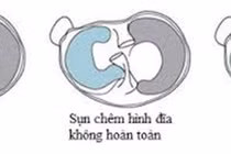  Sụn chêm hình đĩa gây thoái hóa khớp sớm ở trẻ