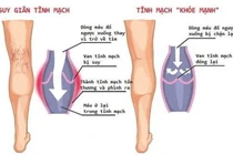 Những thực phẩm tốt cho người bị suy giãn tĩnh mạch