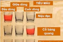 Các nguyên nhân gây đái máu