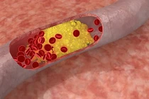 Học hỏi bí quyết chữa mỡ máu cao bằng thảo dược