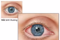 30% bệnh nhân mắc di chứng COVID-19 kéo dài bị viêm kết mạc