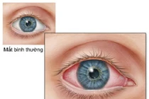 30% bệnh nhân mắc di chứng COVID-19 kéo dài bị viêm kết mạc