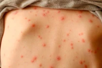 Cẩn thận thủy đậu mùa xuân gây biến chứng gan, thận
