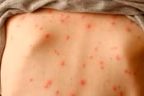 Cẩn thận thủy đậu mùa xuân gây biến chứng gan, thận