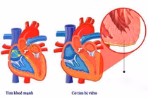 Viêm cơ tim do virus