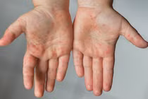 Sử dụng sản phẩm thảo dược cải thiện bệnh tay chân miệng - Xu hướng điều trị mới được chuyên gia đánh giá cao