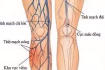 Sau đặt stent động mạch chi có cần điều trị?
