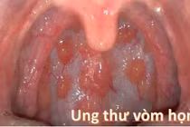 Ung thư vòm họng do quan hệ bằng miệng