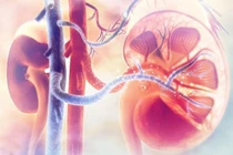Bệnh viêm cầu thận mạn có chữa khỏi được không?