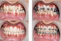 Đau răng sau niềng