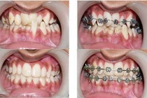 Đau răng sau niềng