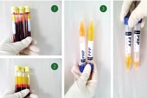 Tác dụng của tách huyết tương trong điều trị