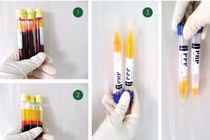 Tác dụng của tách huyết tương trong điều trị