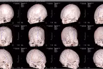 Phẫu thuật tạo hình bằng lưới titan 3D ghép sọ cho nhân viên y tế khuyết sọ