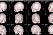 Phẫu thuật tạo hình bằng lưới titan 3D ghép sọ cho nhân viên y tế khuyết sọ
