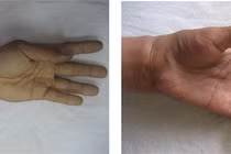 Xử trí khi muốn nối chi thể