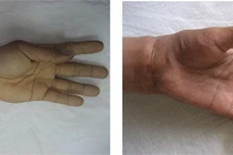 Xử trí khi muốn nối chi thể